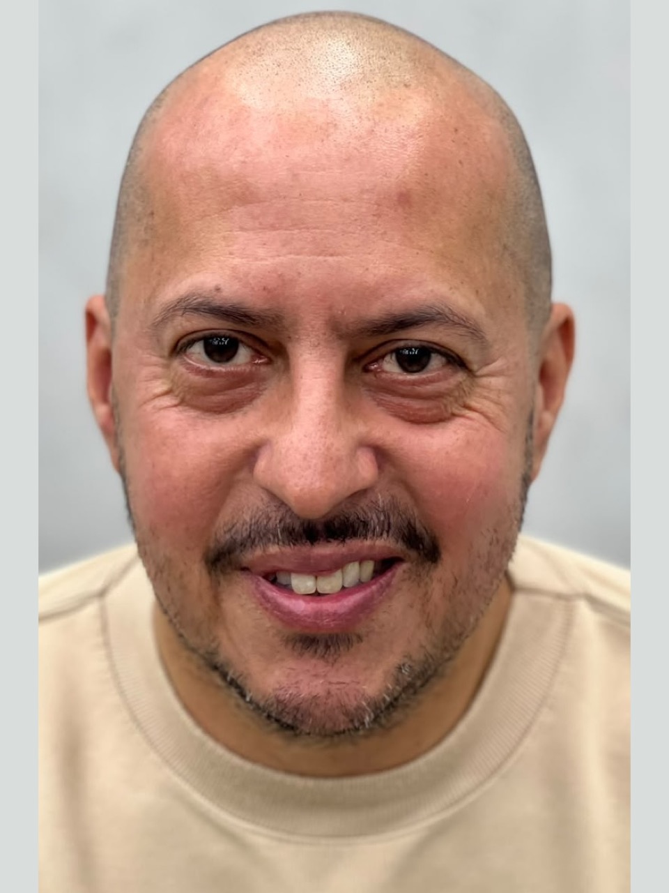 Before Scalp Micropigmentation, case 1