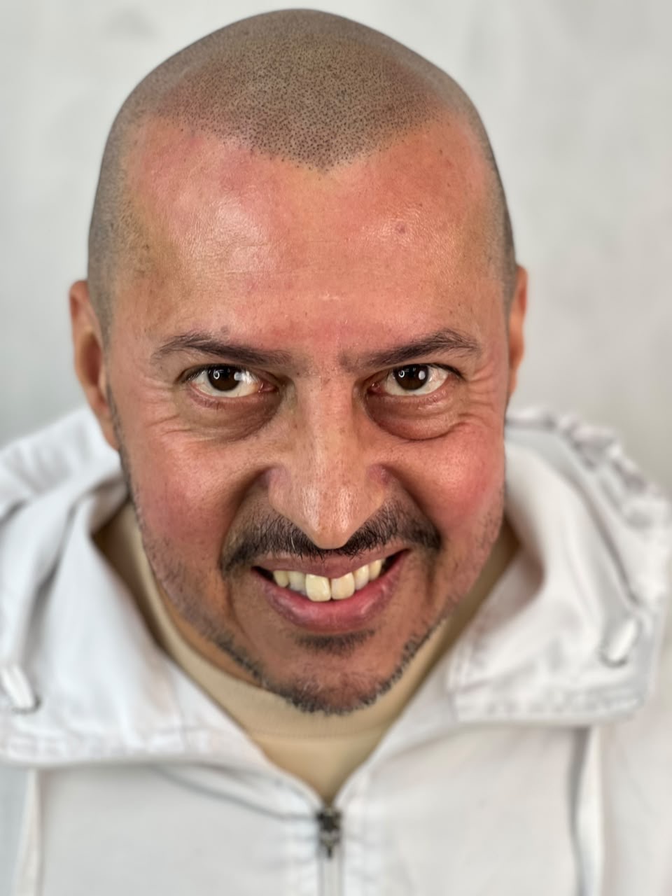 After Scalp Micropigmentation, case 1